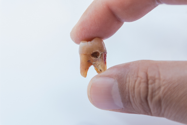 歯の詰め物・被せ物が取れた際の対処法