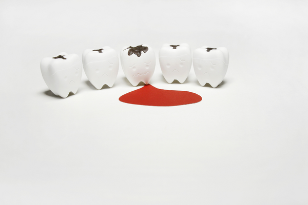 歯茎から出血する原因